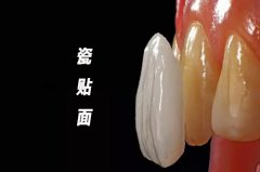合肥做瓷贴面多少钱-牙齿美白可靠吗？