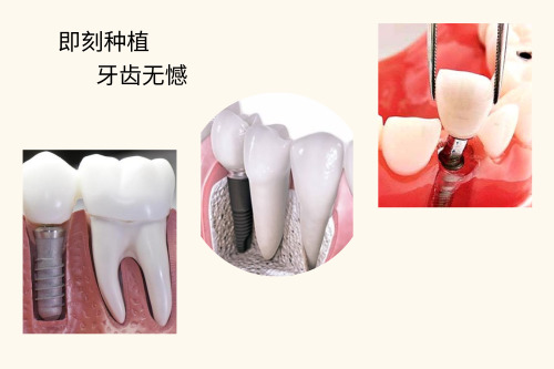 合肥种植牙多少钱一颗-种植让牙齿重生
