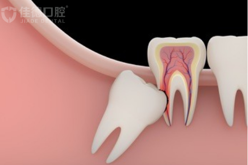 合肥的口腔医院拔智齿价格