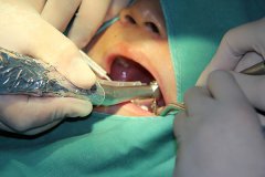 合肥补个牙齿多少钱-救一救坏牙？