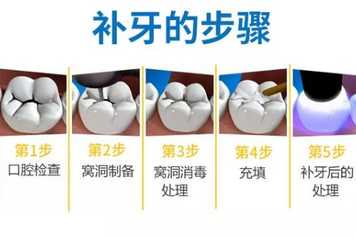 合肥的口腔牙科补牙收费表