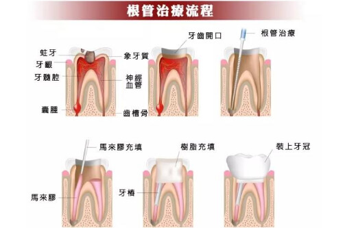 合肥根管治疗费用多少