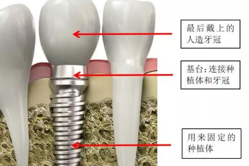 合肥做种植牙要花多少钱