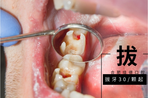 合肥口腔牙科拔牙收费标准