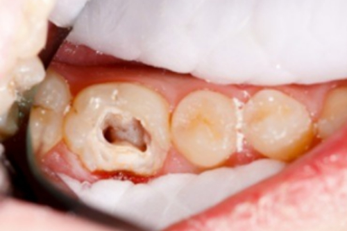 合肥根管治疗牙齿多少钱