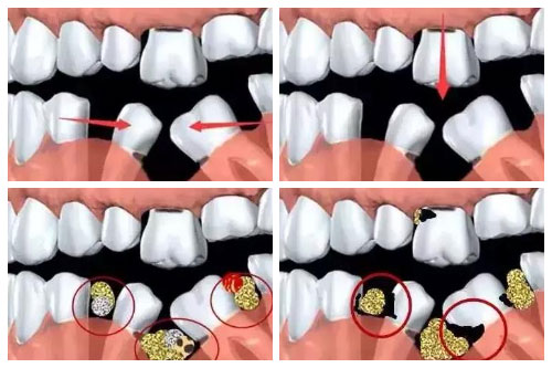 合肥的口腔牙科种植牙多少钱