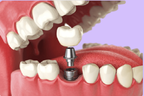 合肥的口腔牙科种植牙多少钱—低至5800元！