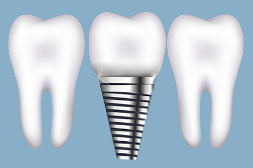合肥的口腔牙科种植牙费用多少？