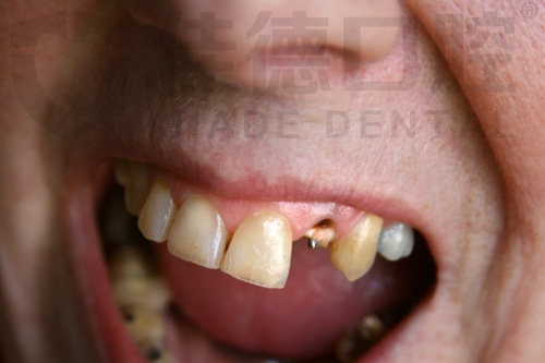 合肥的口腔牙科种植牙多少钱一颗