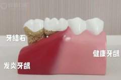 合肥洗牙哪个医院比较好-该不该洗牙？
