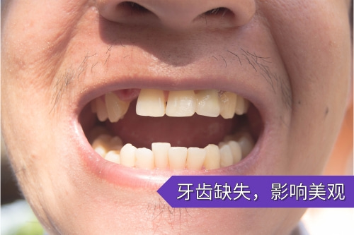 合肥种植牙哪家口腔比较好、合肥佳德口腔