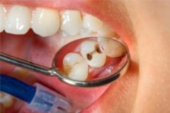 合肥补牙医院多少钱一颗-补过牙的材料会掉吗？