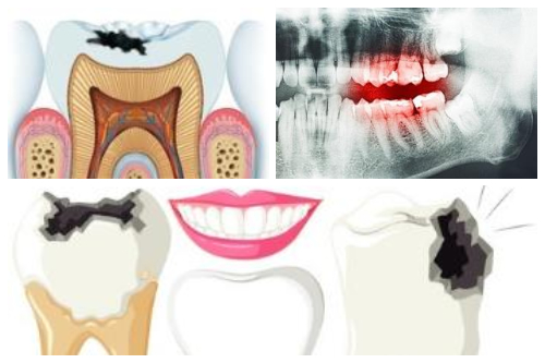 合肥佳德口腔补牙多少钱、蛀了牙补牙