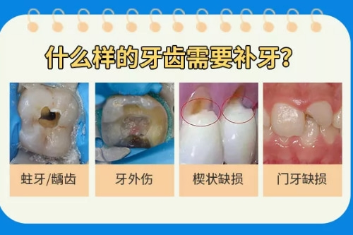 合肥牙科补牙多少钱一颗、补牙收费