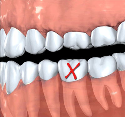 合肥种植牙、佳德口腔、牙齿缺失