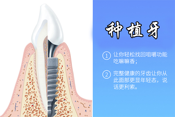 种植牙