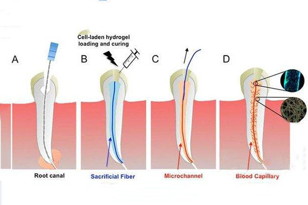 合肥根管的治疗牙齿多少钱-了解才能不吃亏