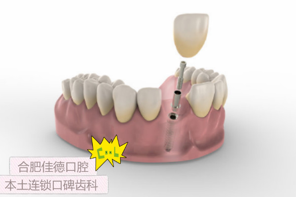 合肥种牙费用是多少