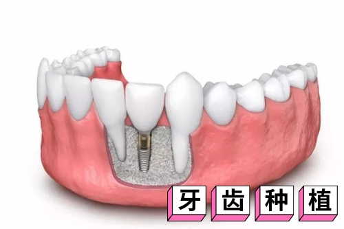 合肥种植牙齿一颗多少钱