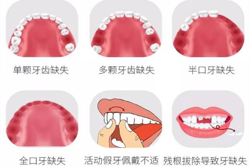 合肥种植牙齿一颗多少钱