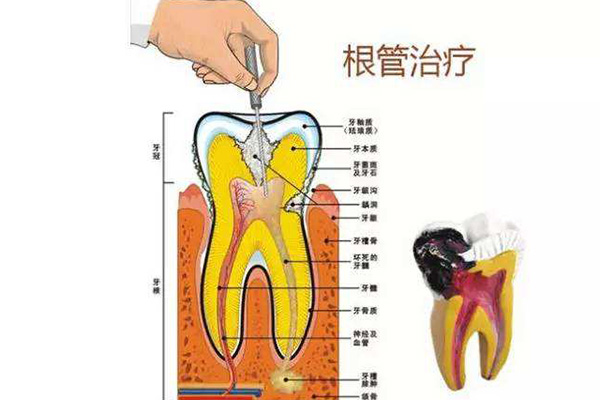 合肥牙齿做根管的治疗多少钱
