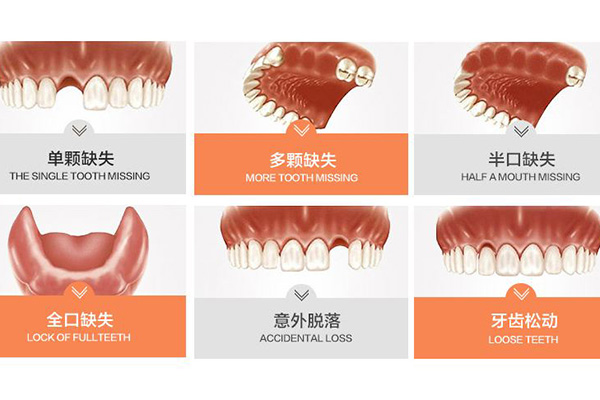 合肥种植牙多少钱