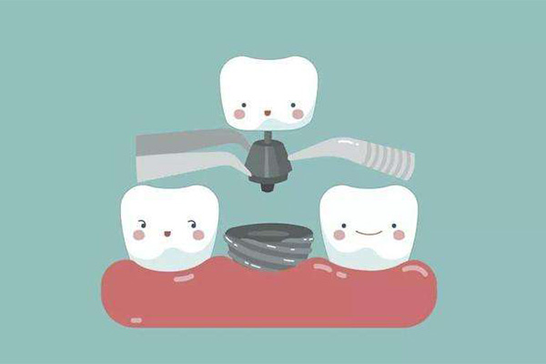 合肥种植牙价格表