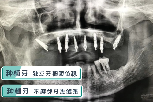 合肥种植牙齿一颗多少钱