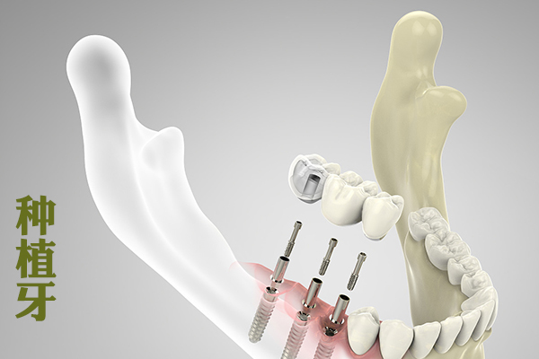 种植牙