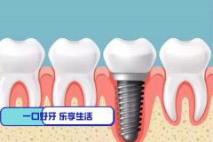 合肥满口种植牙可以刷医保吗—摆脱“一望无牙”？