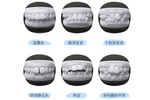 合肥整牙哪里好-给你一口整齐小白牙！