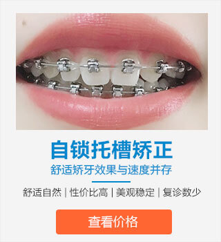 自锁托槽矫正