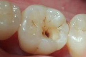 乳牙龋坏的发病原因？