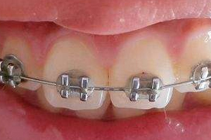 儿童牙齿矫正什么时候好？