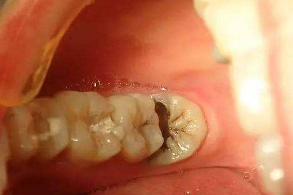 牙齿衰老会引起哪些病症？