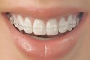 前牙开颌矫正需要注意什么？