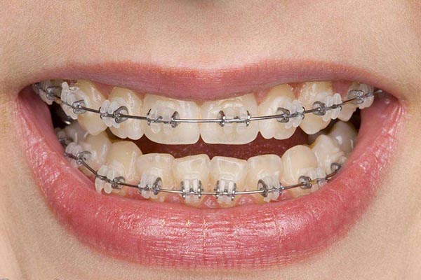 合肥小孩牙齿牙齿错位怎么矫正？