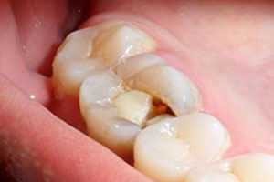 一系列牙齿疾患产生的根源是什么?治疗牙齿疾患