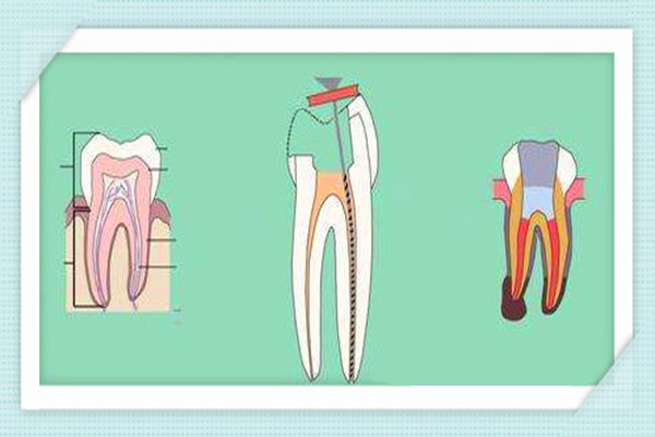 根管的治疗