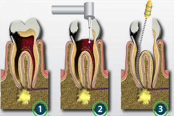 根管的治疗