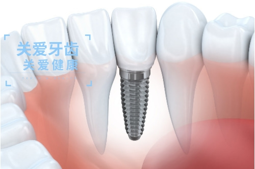 合肥牙齿种植、合肥种植牙、种植牙价格