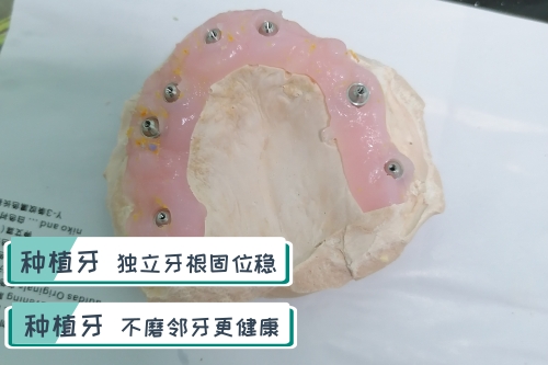 合肥种植牙、合肥佳德口腔