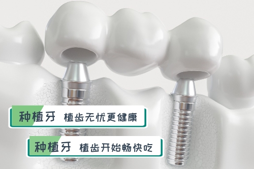 合肥种植牙、合肥佳德口腔