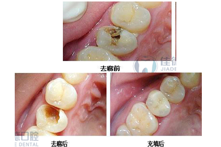 补牙后仍然牙痛怎么办？