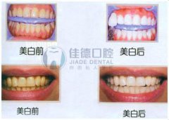 清理牙结石的好办法？