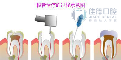 牙痛了怎么快速的止痛呢？