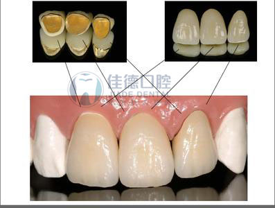 二氧化铝全瓷牙和二氧化锆全瓷牙的区别