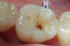 龋坏形成原因有哪些