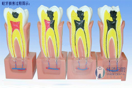 蛀了牙要补吗