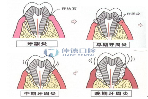 牙周病